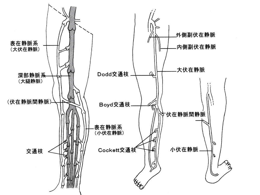 下腿潰瘍 下肢静脈瘤診療ガイドライン 案 用語の説明